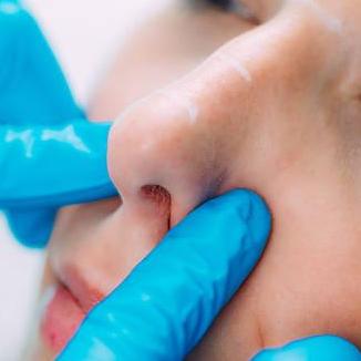 Rhinoplasty  In Riyadh