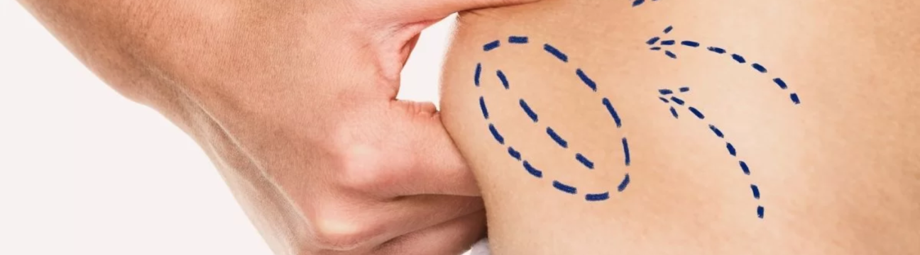 Liposuction Surgery