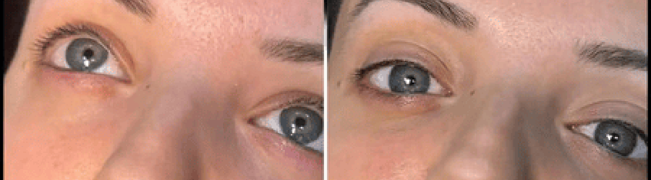Dermal Fillers
